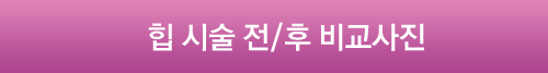 힙시술전/후비교사진