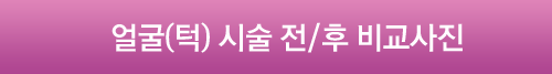 얼굴(턱)시술전/후비교사진
