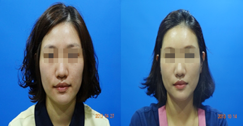 필러시술 전후